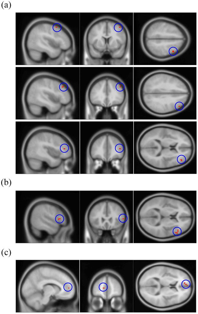Figure 2 from “Functional MRI and ApoE4 genotype for predicting cognitive decline in amyloid-positive individuals”