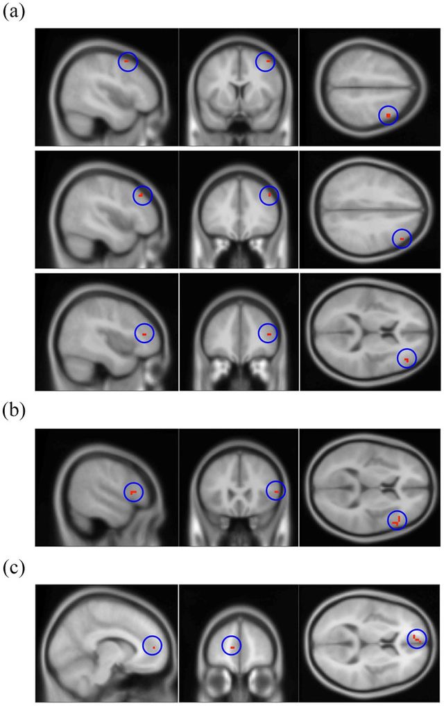 Figure 2 from “Functional MRI and ApoE4 genotype for predicting cognitive decline in amyloid-positive individuals”