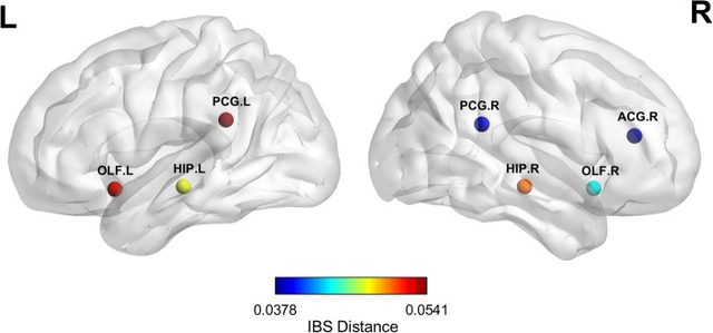 Figure 2 from “Exploring morphological similarity and randomness in Alzheimer's disease using adjacent grey matter voxel-based structural analysis”
